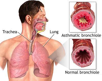 Inhaled steroid for asthma generic
